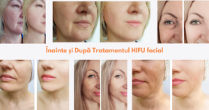 Before & After hifu facial